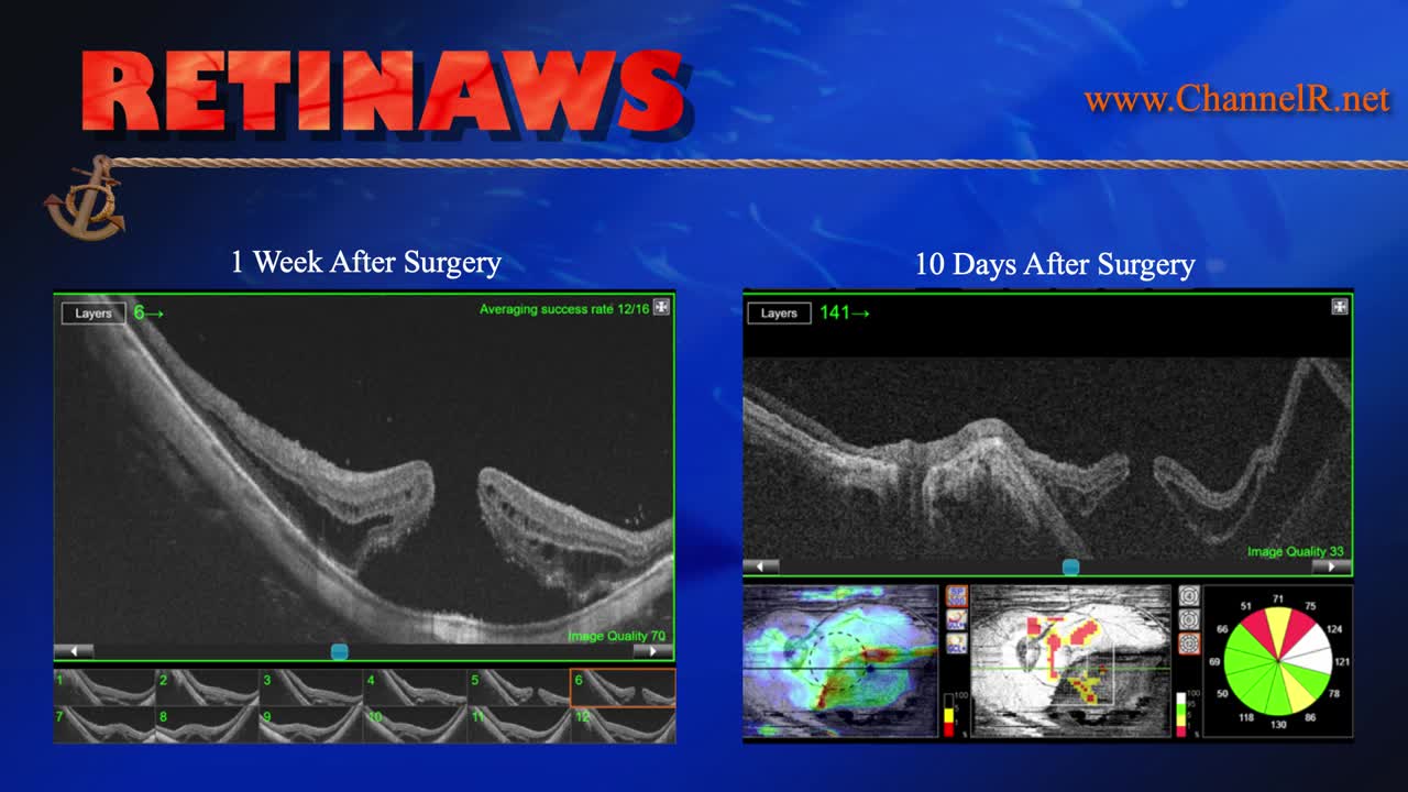 Macular Hole and High Myopia