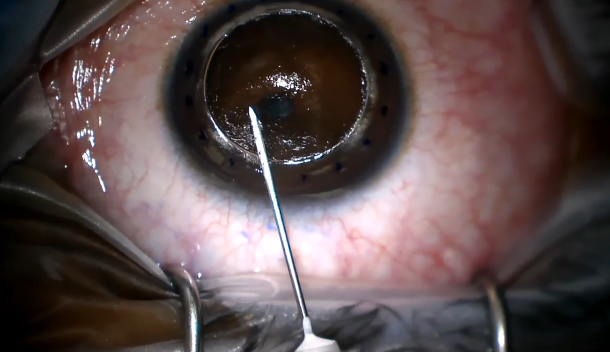 Big Bubble DALK for Advanced Keratoconus in a Teenage Patient