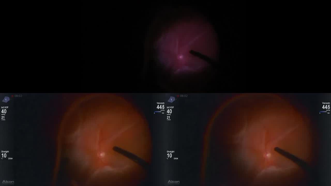 Decreased Illumination
