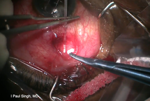 Clearpath Small Incision