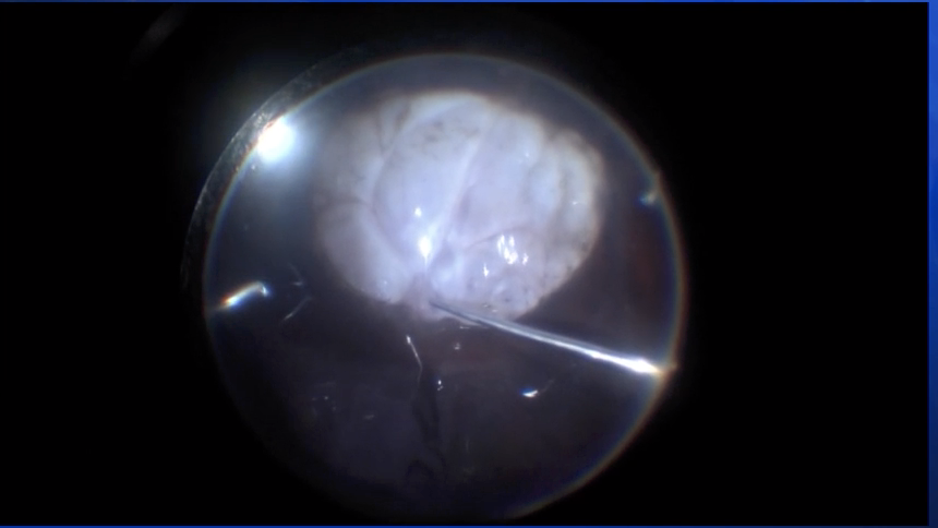 Coloboma and Retinal Detachment