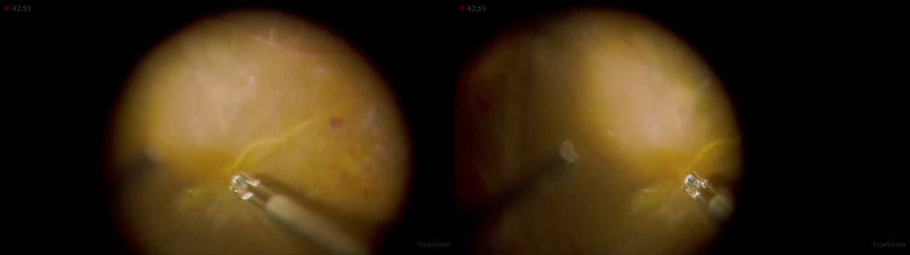 Sharkskin Forceps, Beveled Cutters, and Color Filtering on Heads-Up 3D Viewing