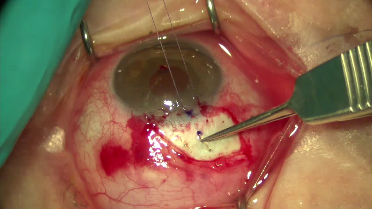 Open Xen Implantation
