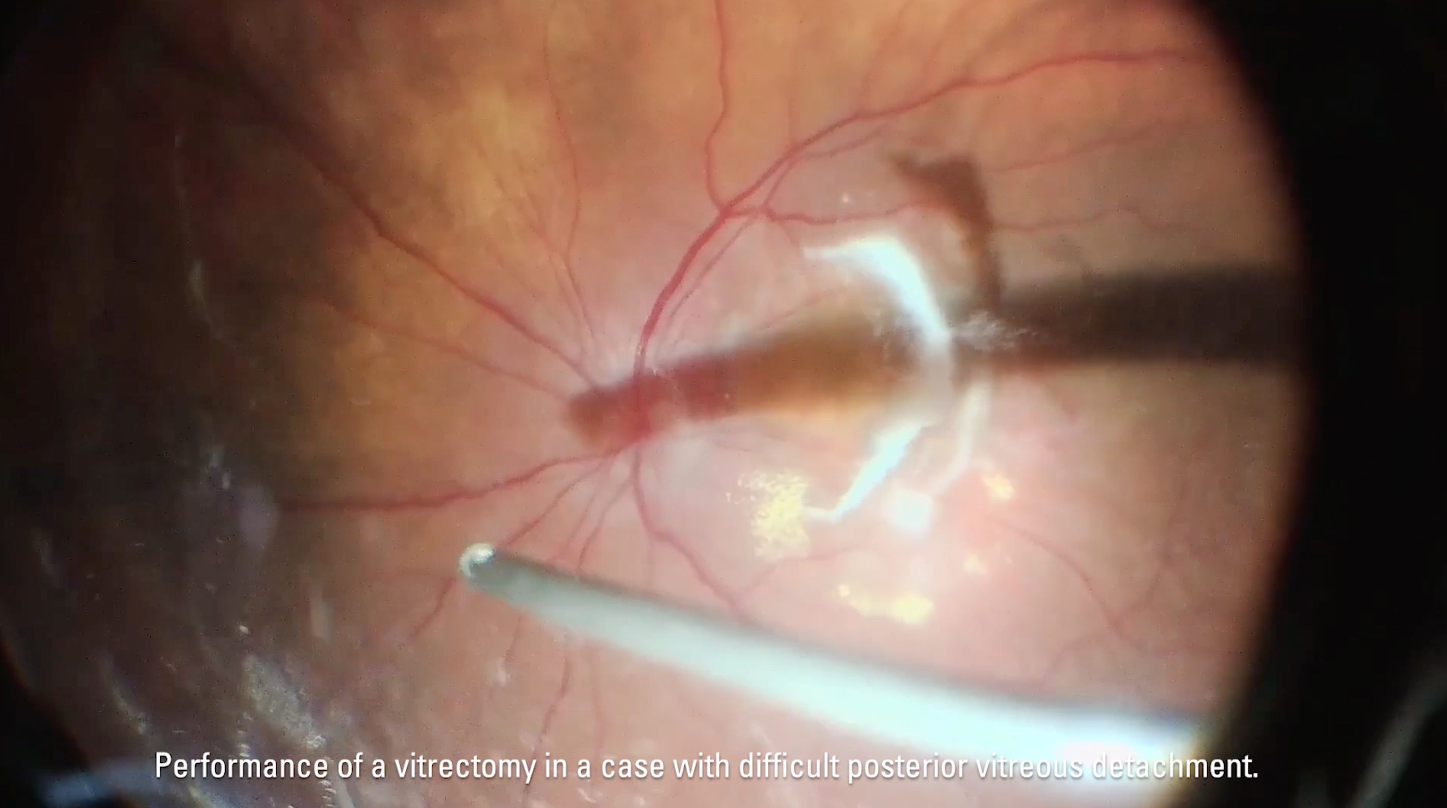 Autologous Transplant of Choroid in Exudative Maculopathy with the Proveo 8 Microscope