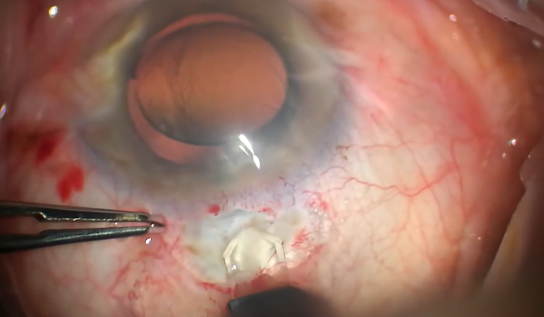 Cataract Wound Gape Transposition Procedure
