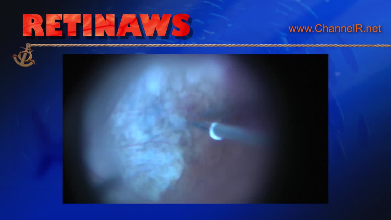 Retinal Detachment & ILM Peeling