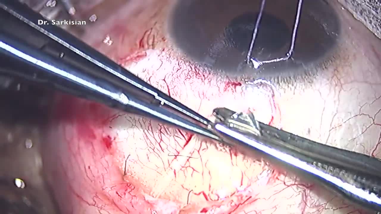Using a Cornea Patch Graft to Cover a Glaucoma Drainage Implant