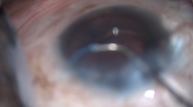 Viscocanaloplasty and Goniotomy