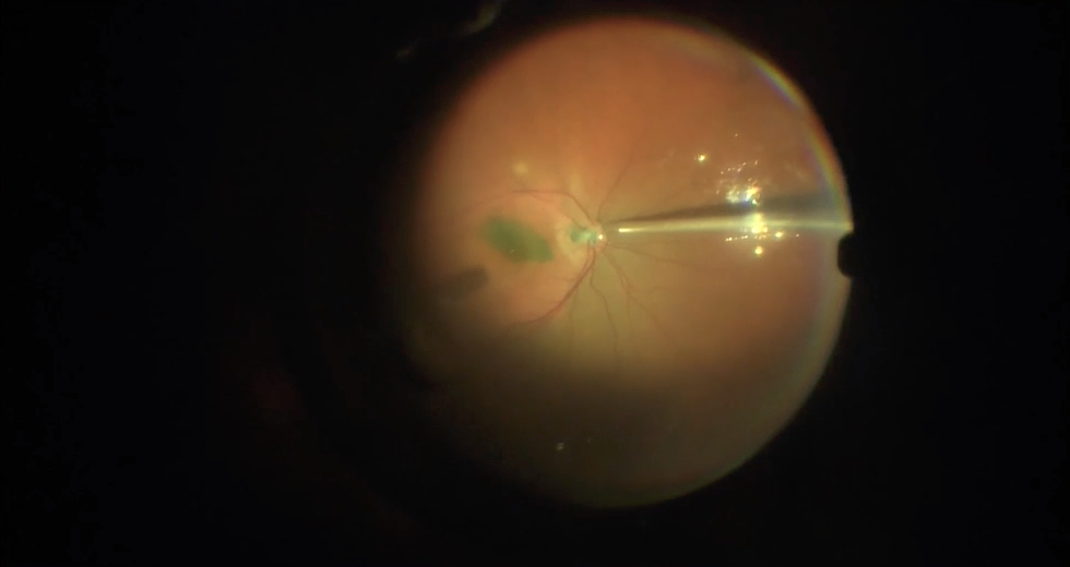 Optic Nerve Pit