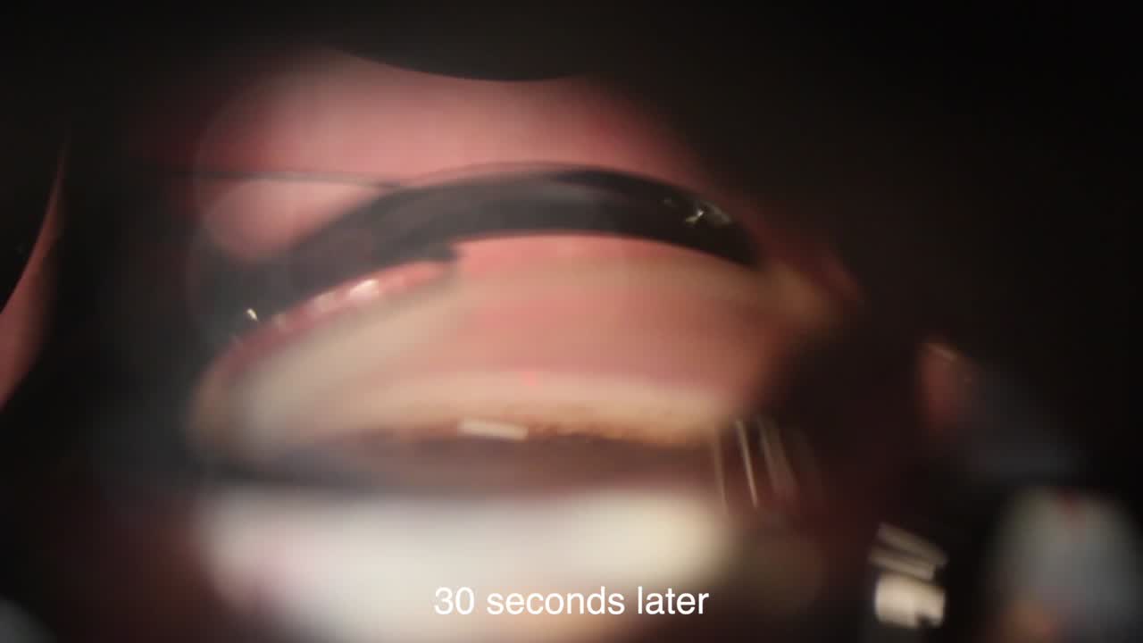 Durysta Slit Lamp: No Speculum or Second Instrument