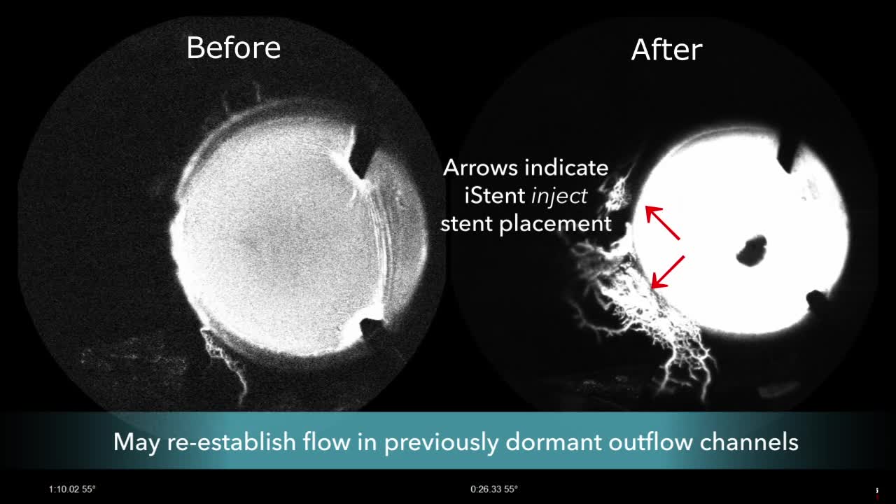The Importance of the Trabecular Meshwork