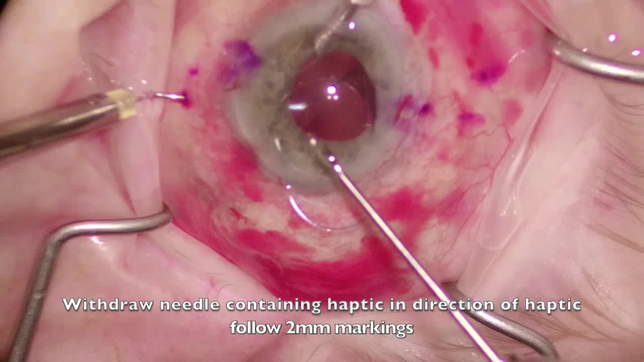 Scleral IOL Fixation With the Yamane Technique