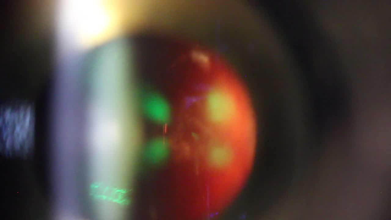 Laser Floater Treatment with Coaxial Illumination