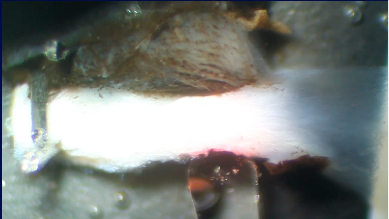 Transcleral Micropulse Laser Dynamically Alters Ciliary Muscle and Aqueous Outflow Pathways