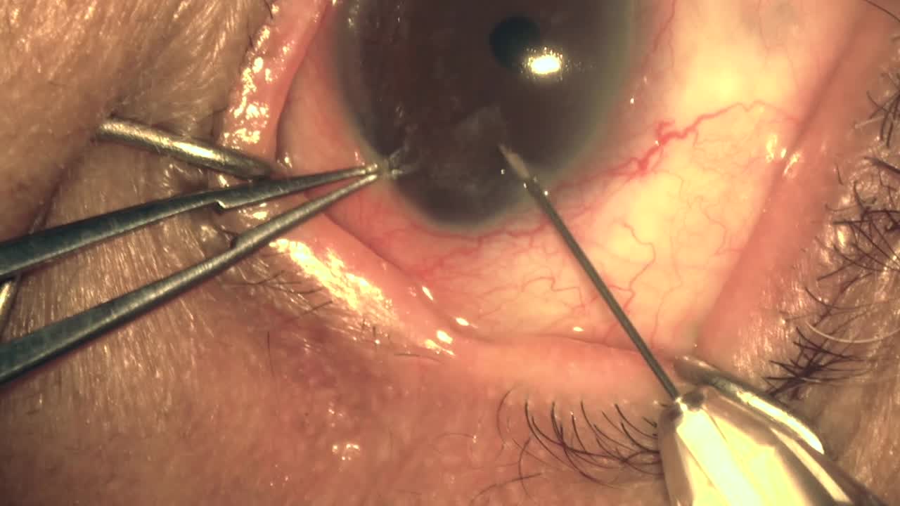 Durysta Implantation