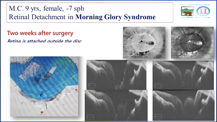 Morning Glory and Retinal Detachment