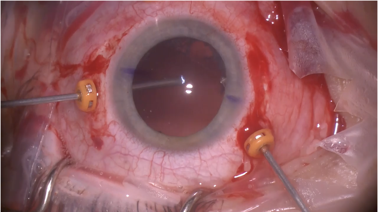 Anterior Vitrectomy