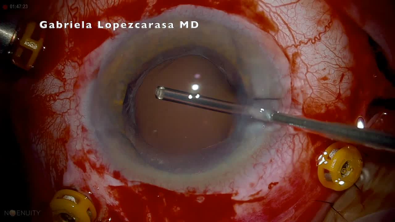 Vitreous Hemorrhage, Retinal Tears, and Inferior Retinal Detachment