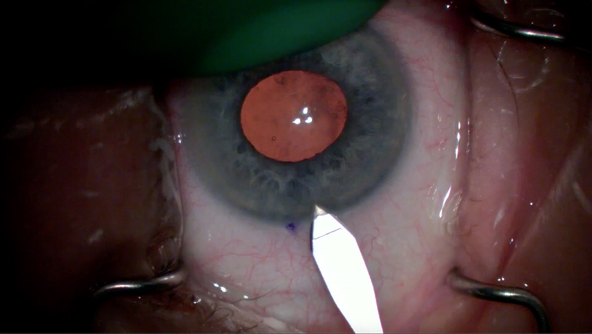 miLOOP Training: Temporal Two Handed Technique in Premium Toric IOL case with Dense White Nucleus stained with Trypan Blue
