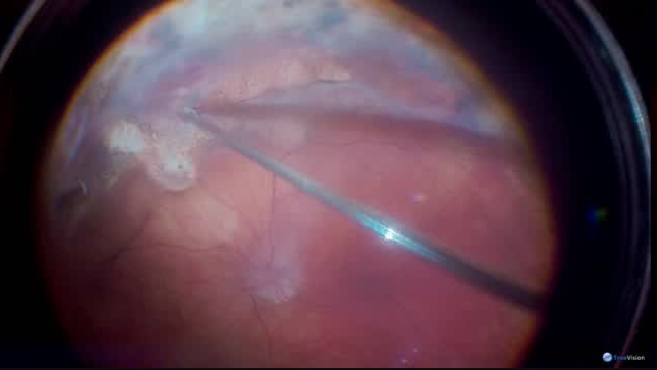 Retinectomy with Scissors