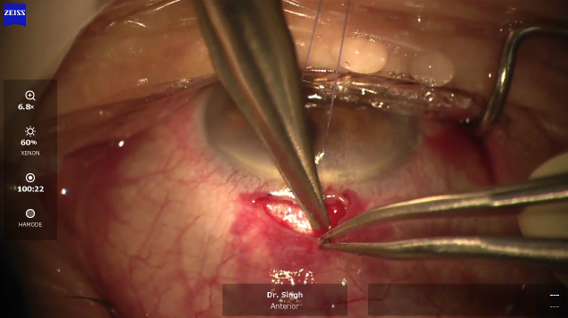 Xen External Cutdown Technique