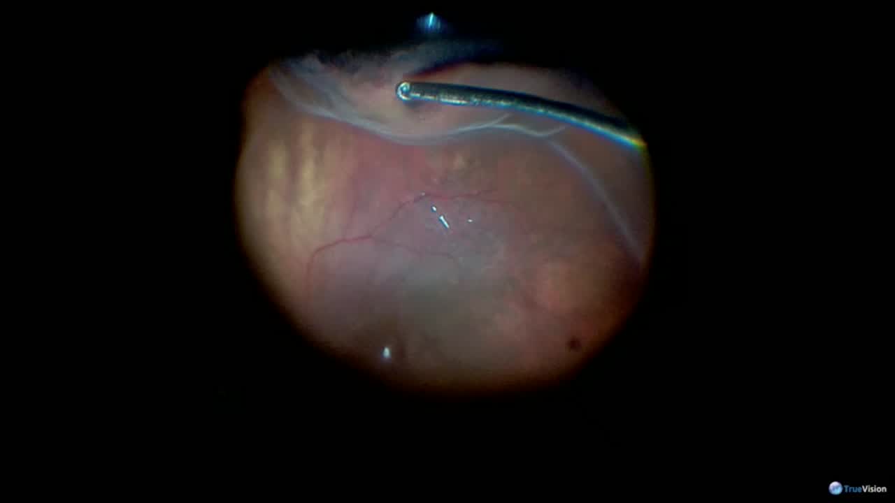 Subluxated IOL and Retinal Detachment - Eyetube