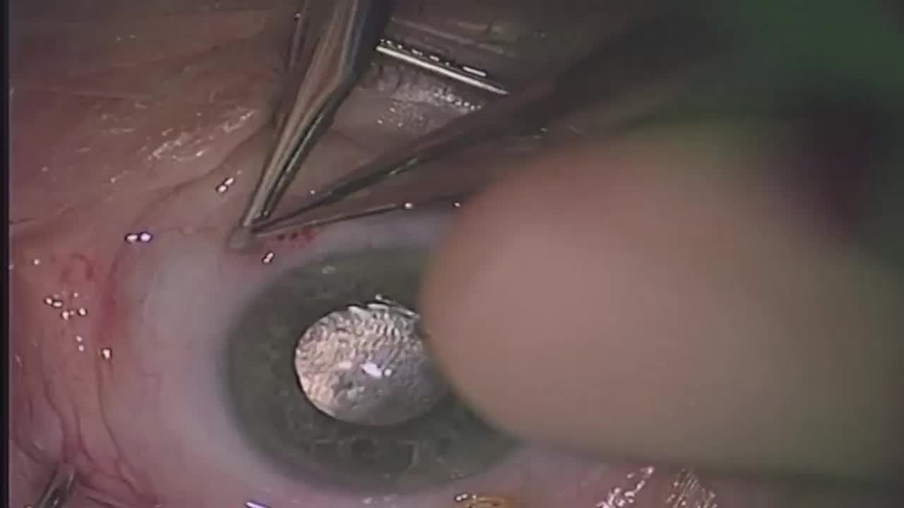 Lensectomy After Cataract Extraction