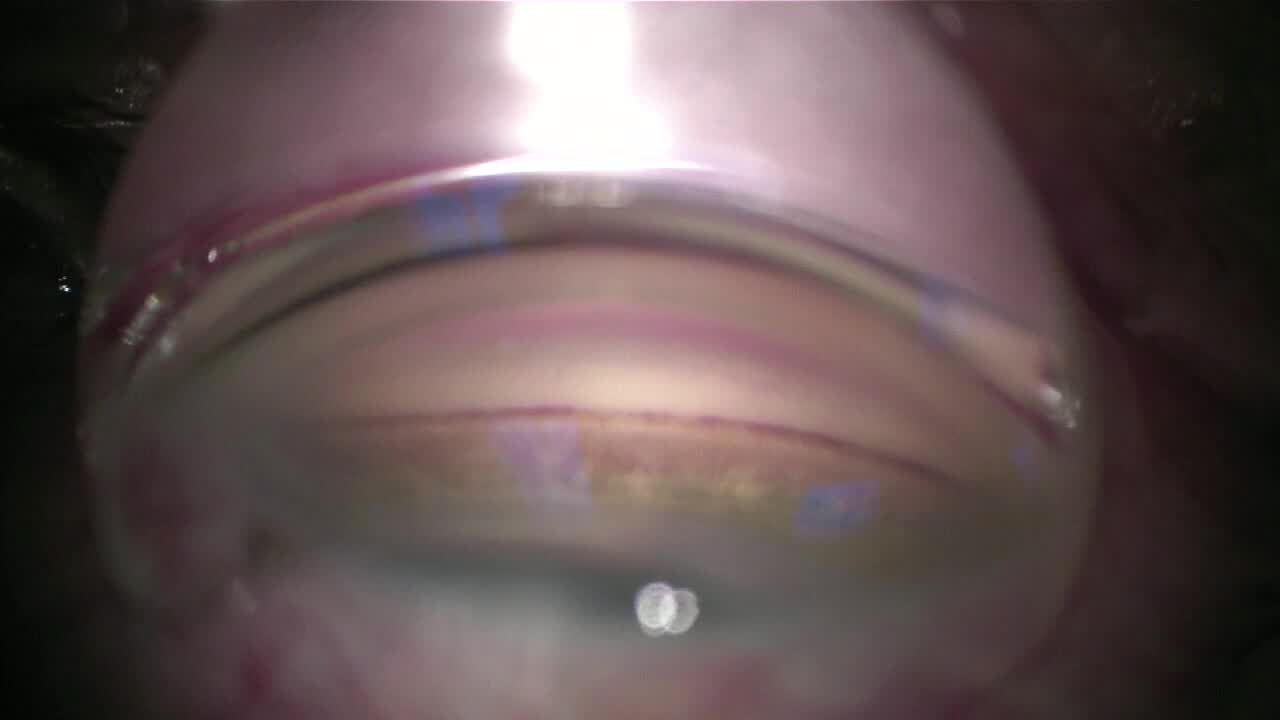 iStent Inject W Implantation