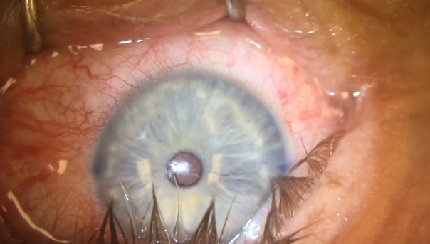 Correction of Astigmatism With Astigmatic Keratotomy 