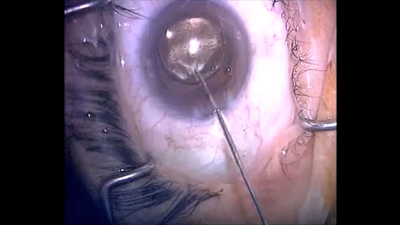 IOL Exchange for Refractive Surprise