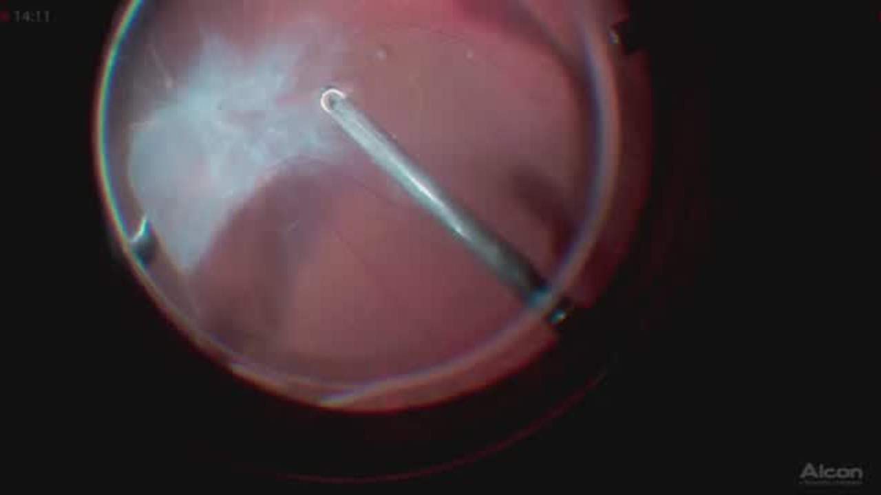 Thin Mobile Retina Complicates an Adherent Tractional Retinal Detachment [FLOREtina Live Surgery]