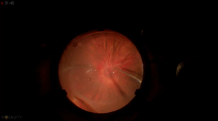 Giant Tear & Retinal Detachment