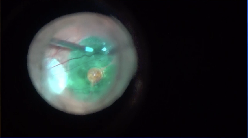 Macular Hole and Retinal Detachment