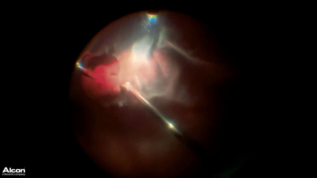 Scleral Buckling