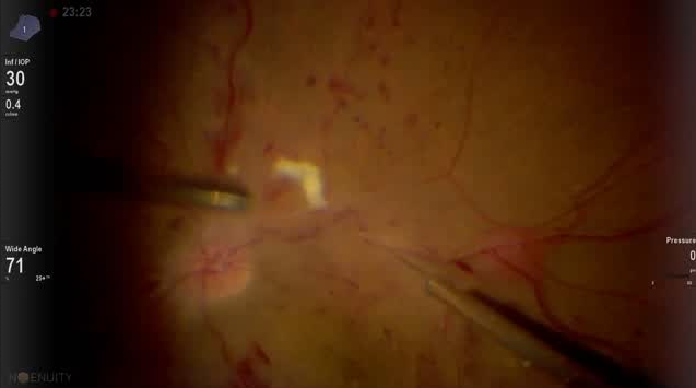Intravascular Injection of tPA in a Case of CRVO