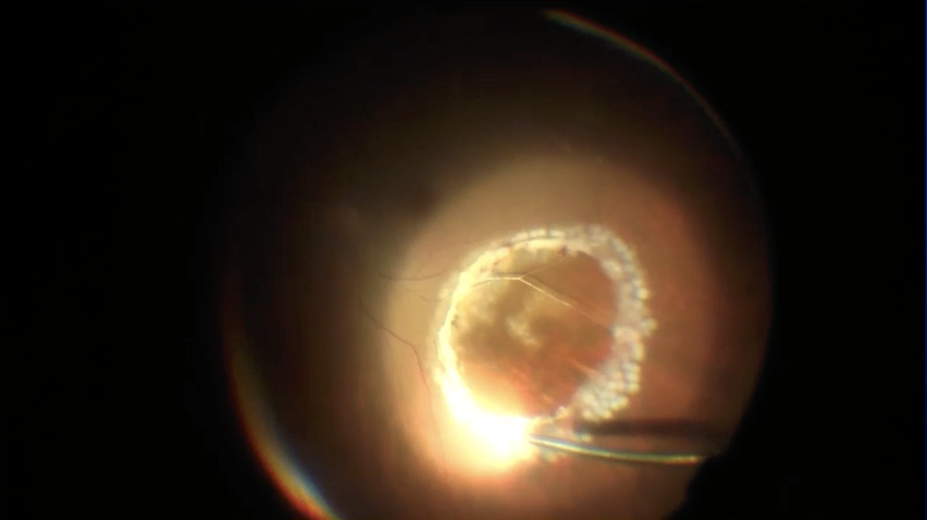 Vitreous Biopsy