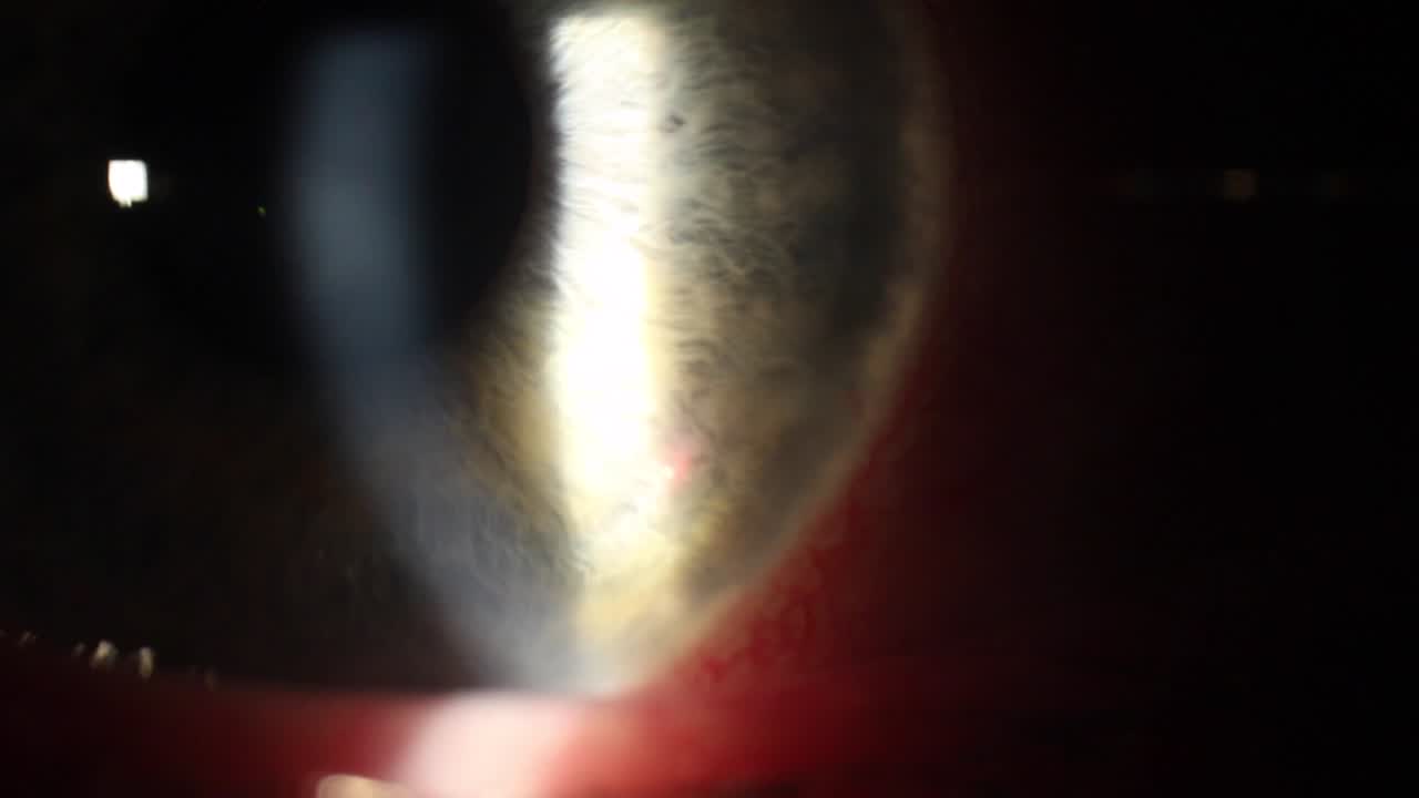 Durysta Implantation at the Slit Lamp