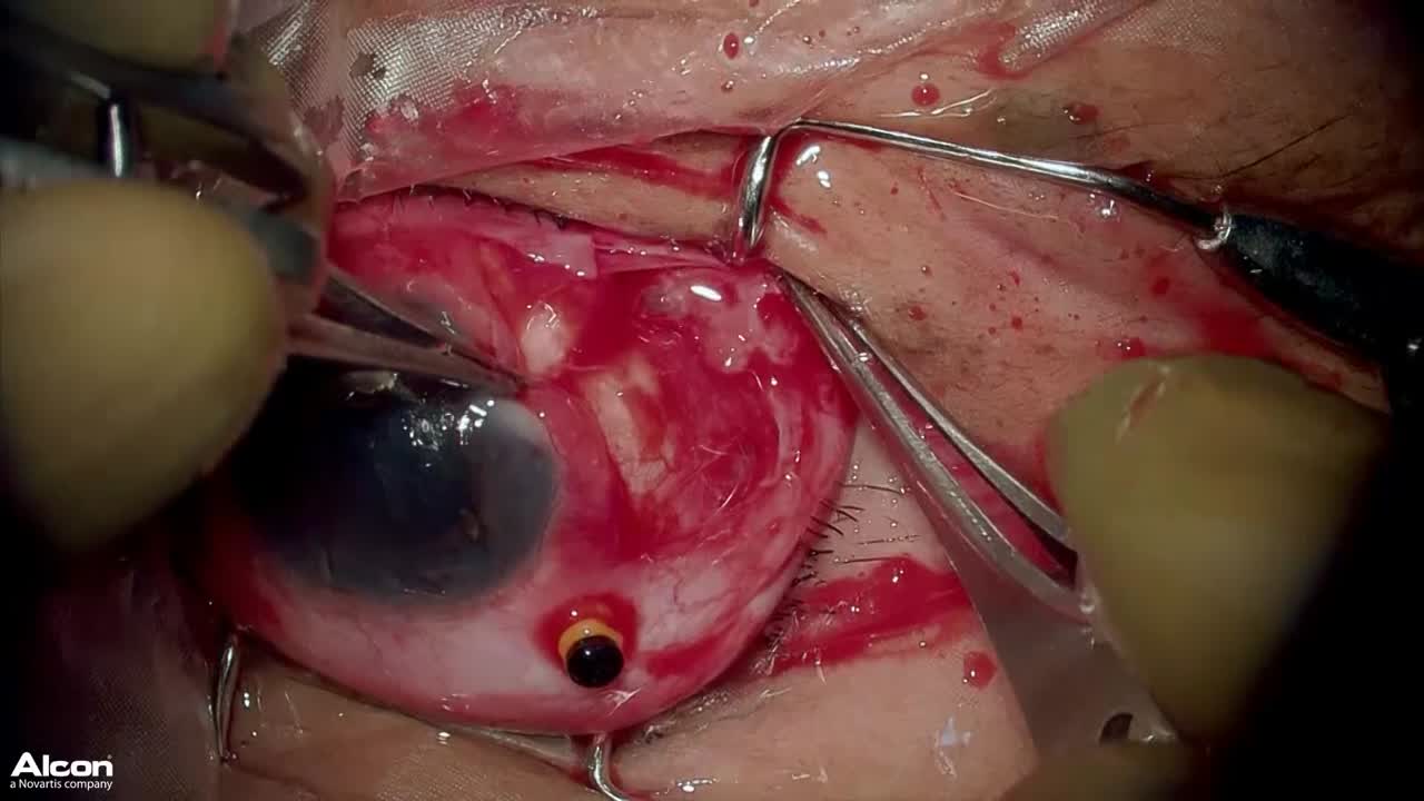 Choroidal Folds