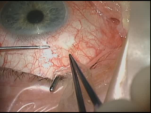 Myopic Patient Encounters Failed Needling