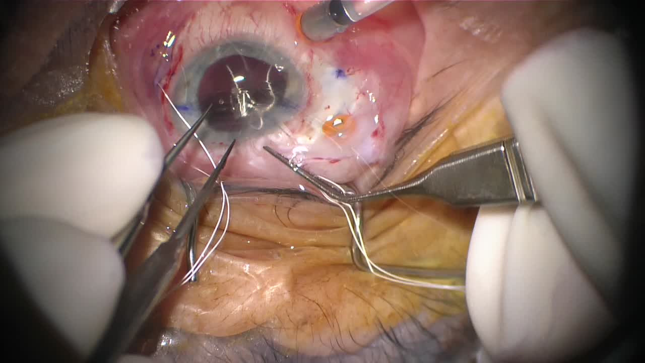 MX60 Secondary IOL