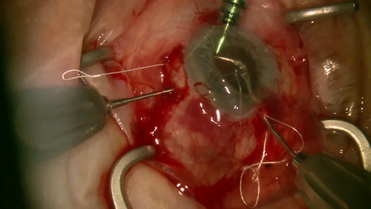 Disaster Strikes: A Technique for Scleral Suturing a Single-Piece Multifocal