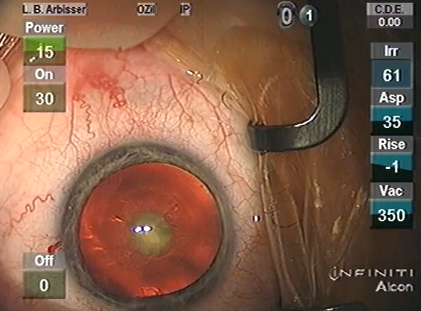 Posterior Polar Cataract My Way