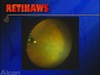Suprachoroidal Cannula Insertion 