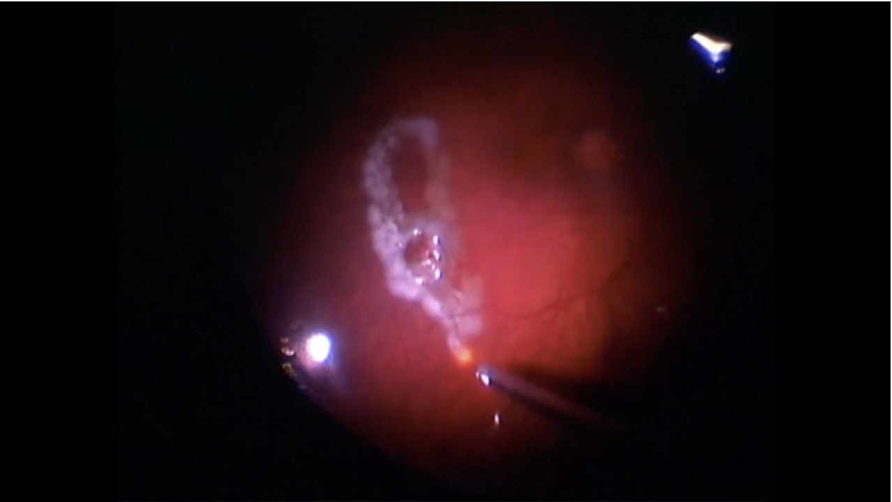 Retinoschisis and Retinal Detachment