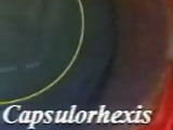 How to Conquer Zonular Dialysis