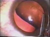 Difficult Cases - Dislocated Crystalline Lens