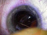 Explanting a Crystalens IOL
