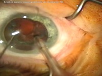 Pop and Prechop - A Novel Safe Supracapsular Phacoemulsification Technique