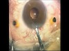 Iris Claw Lens