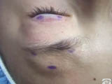 Frontalis Suspension with Ptose-Up
